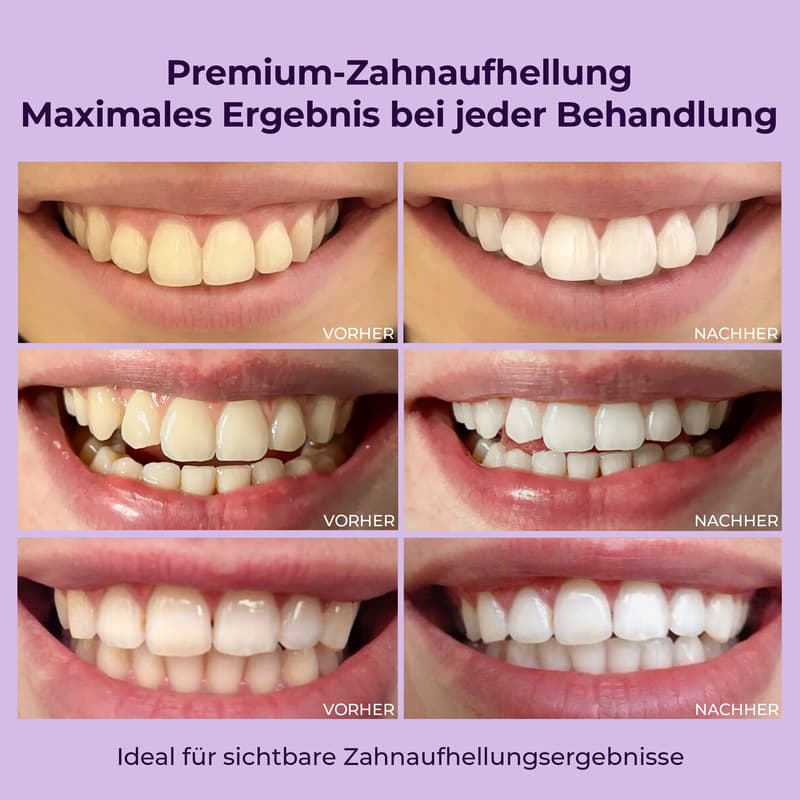 OnlySmile Zahnaufhellungsset (Starterkit)